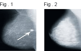 breast-density-figures - The Pink Journey Foundation